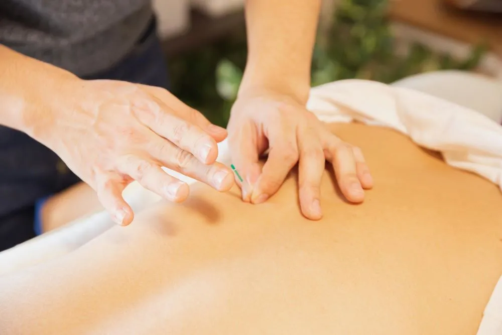 Acupuncture needles being placed on a person's back for treatment.